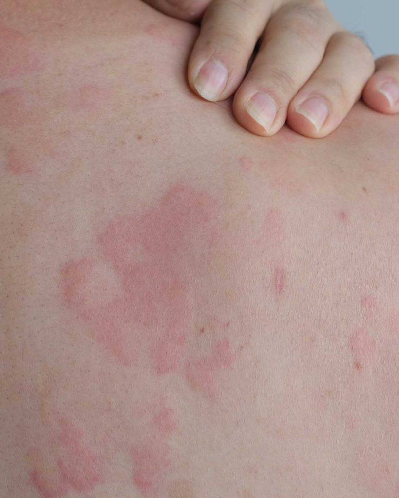 Got red, itchy welts on my back. Doctor’s appointment is weeks away. Any tips to calm it down?