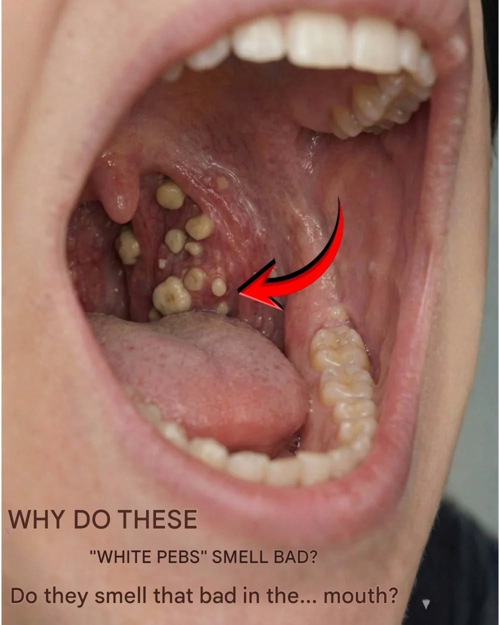 What Are Those Smelly White “Stones” in the Mouth That Cause Terrible Bad Breath?