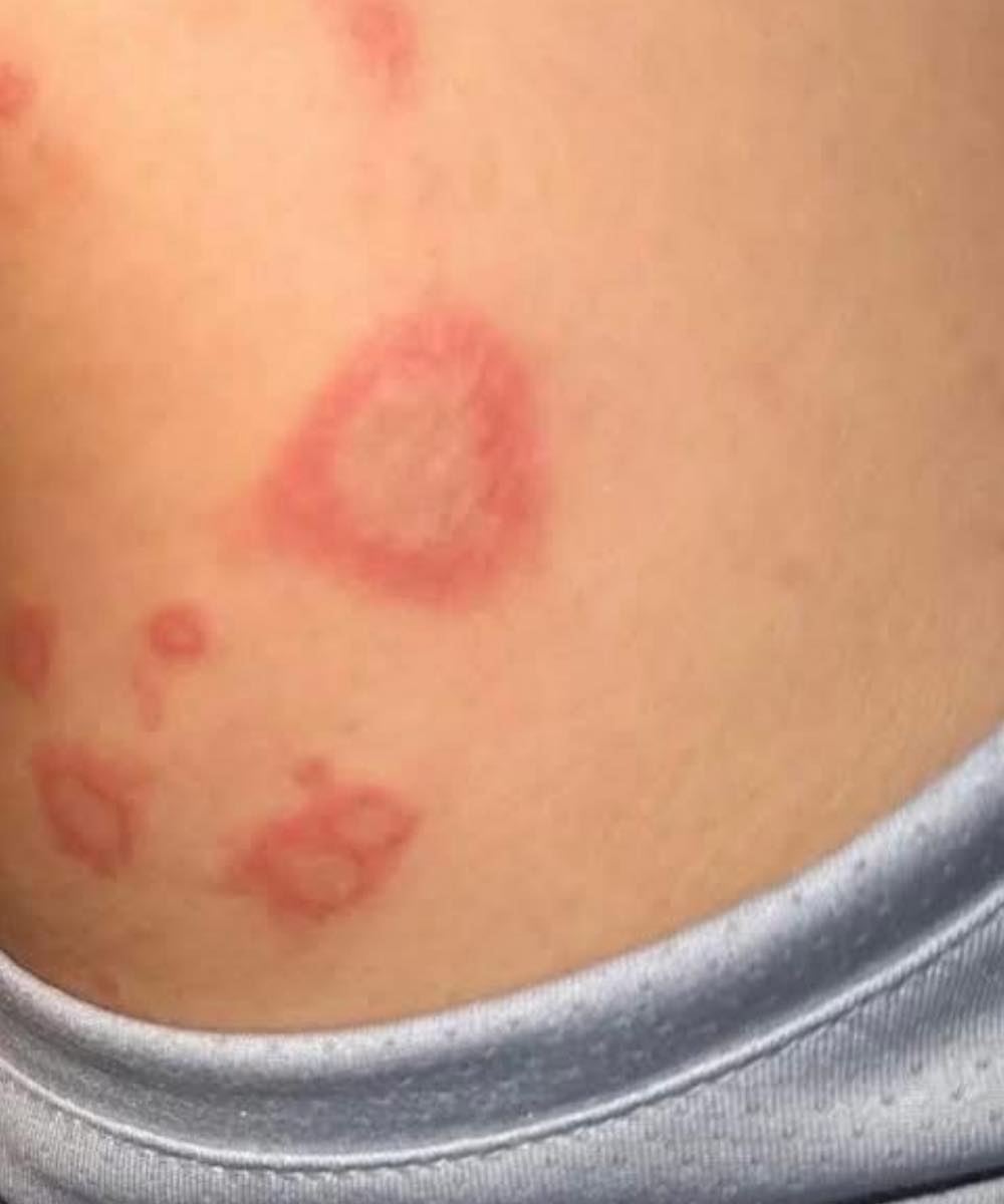 My 15 year old son been at his Nanny house for the weekend and he came back home with different sizes of bumps ..